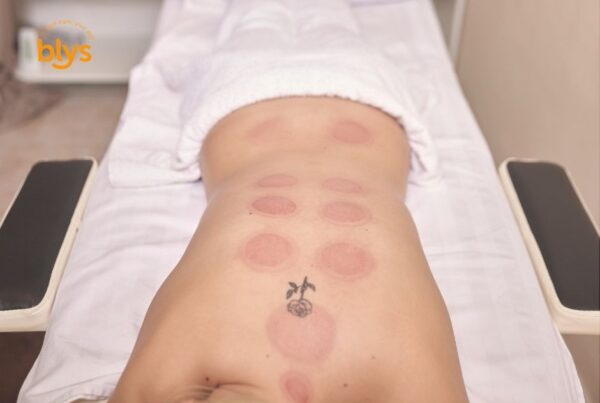 What is cupping therapy