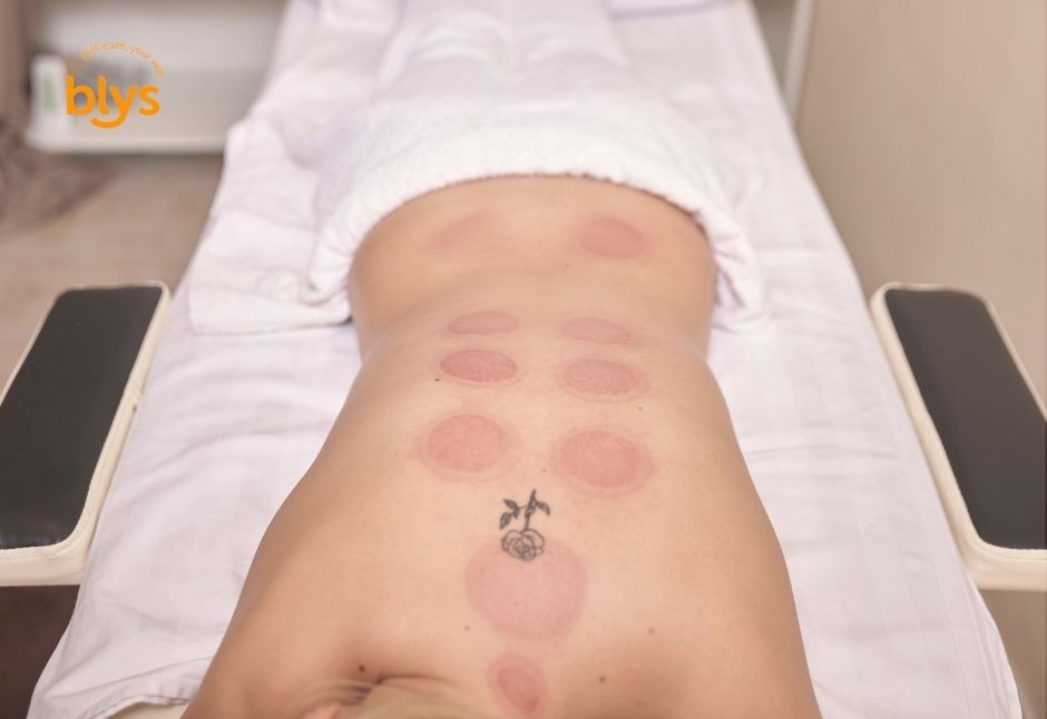 What is cupping therapy