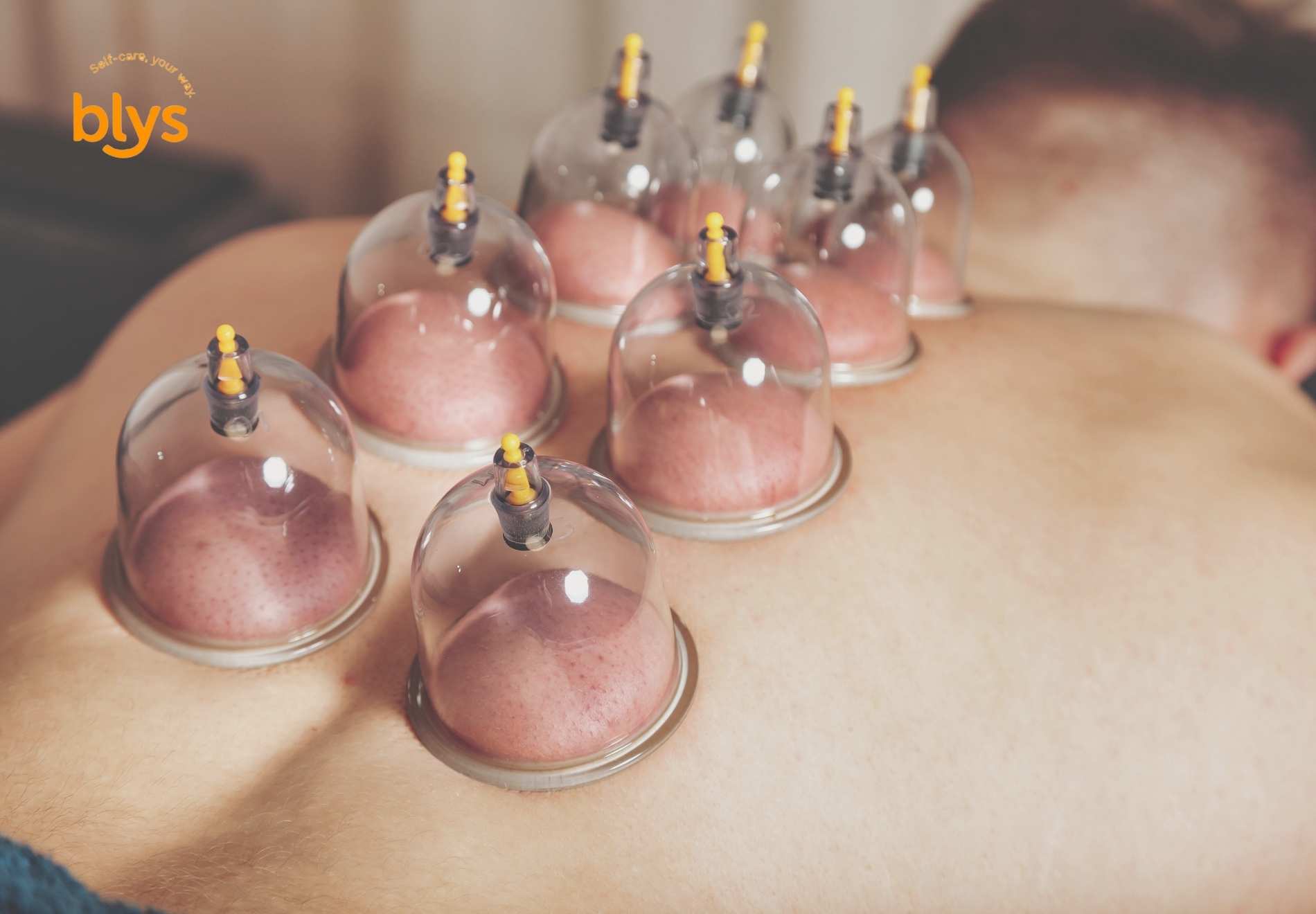 Cupping Therapy for Athletes