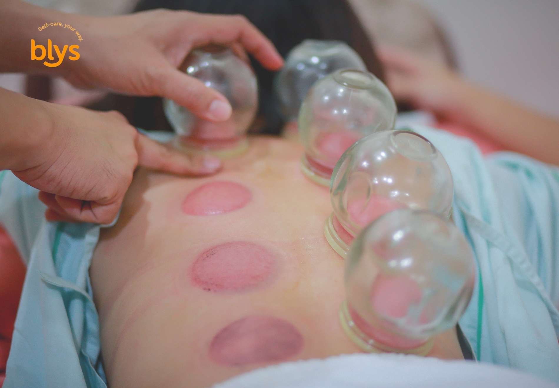 Types of Cupping Therapy