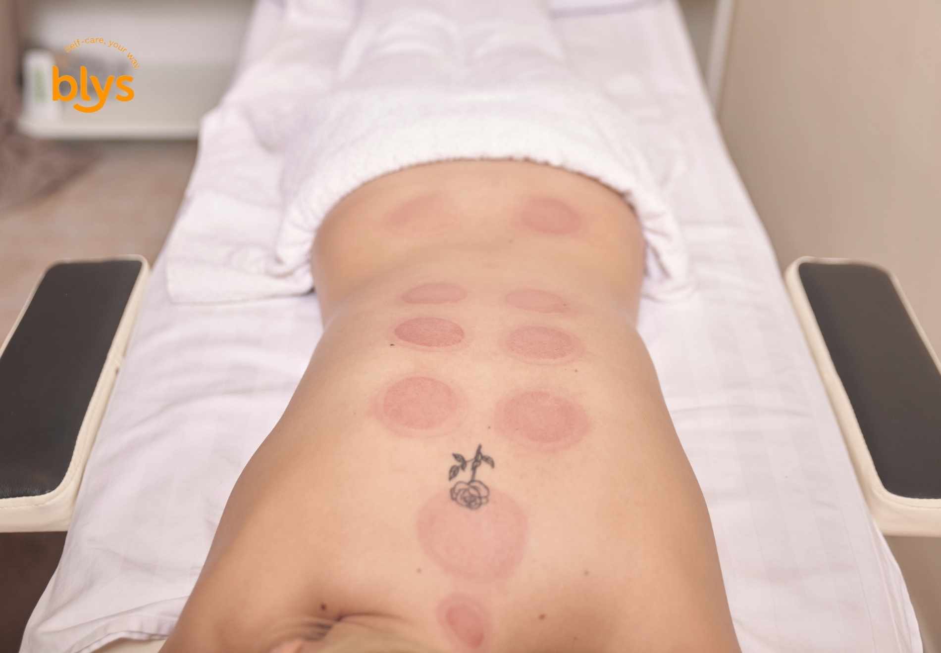 What is Cupping Therapy banner