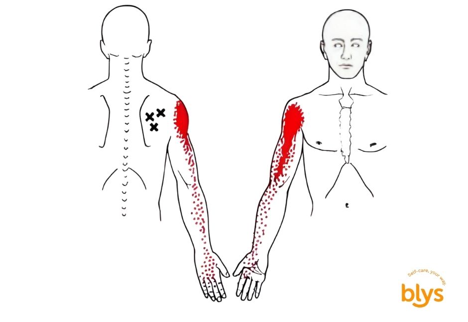 Infraspinatus Trigger Points