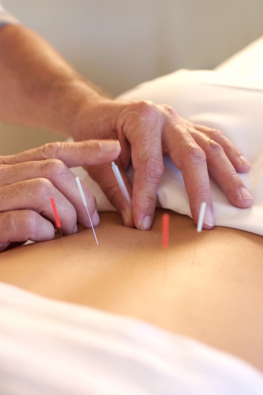 best acupuncture